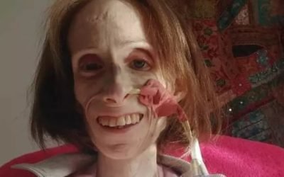 Woman starving to death due to rare condition tragically dies just days before life-saving op