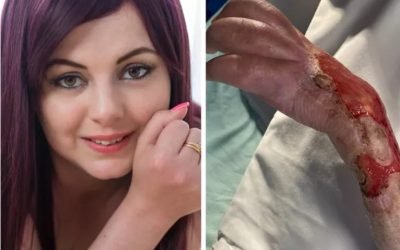 Woman who cut her arm while saving someone from drowning is now desperate to have it amputated and replaced with a prosthetic